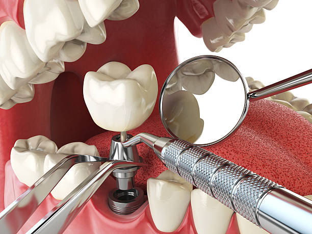 Best Emergency Root Canal Treatment in Old Saybrook Center, CT
